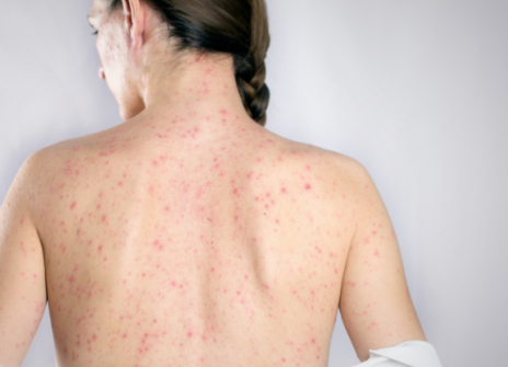 Masern, Mumps und Röteln (MMR)